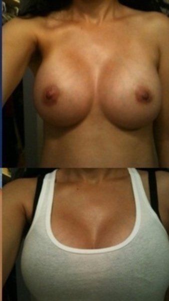 Chia sẻ hành trình nâng ngực chảy xệ kết hợp đặt túi gel silicon 425cc, độ nhô cao của mẹ trẻ sau sinh