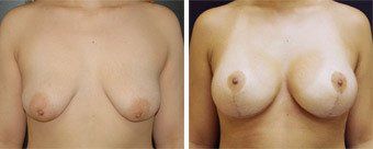 20 tuổi, nâng ngực chảy xệ kết hợp đặt túi gel silicon 475cc độ nhô cao, dưới cơ