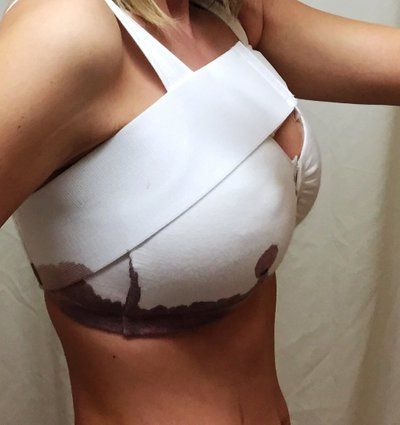 Nâng ngực chảy xệ kết hợp đặt túi độn ở cô gái có bộ ngực chảy xệ di truyền, 32 tuổi, cao 1m62, nặng 53kg