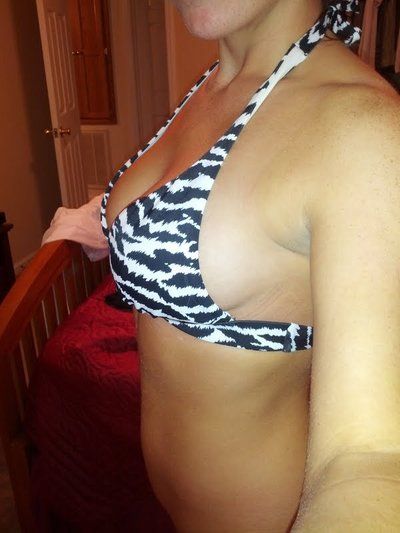 Hành trình “hô biến” ngực chảy xệ trở nên cao đầy với túi gel silicon Mentor 275cc độ nhô cao