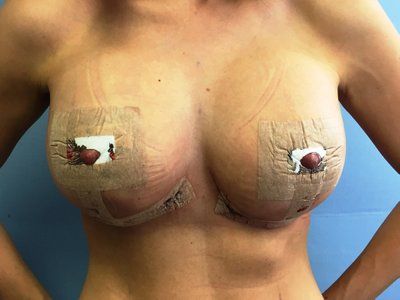 Nâng ngực chảy xệ kết hợp đặt túi độn ở cô gái có bộ ngực chảy xệ di truyền, 32 tuổi, cao 1m62, nặng 53kg