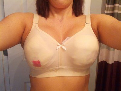 Hành trình “hô biến” ngực chảy xệ trở nên cao đầy với túi gel silicon Mentor 275cc độ nhô cao