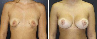 20 tuổi, nâng ngực chảy xệ kết hợp đặt túi gel silicon 475cc độ nhô cao, dưới cơ