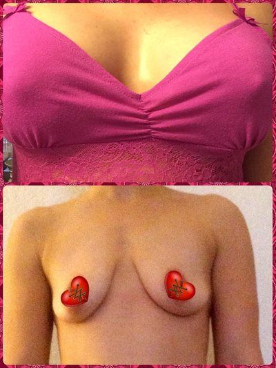 Nâng ngực chảy xệ qua đường mổ dọc đứng hình cây kẹo kết hợp đặt túi độn 325cc