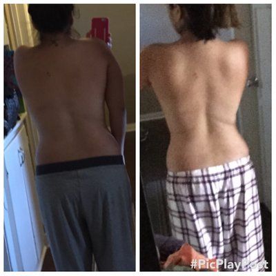 Mẹ 2 con với hành trình nâng ngực chảy xệ qua đường mổ dọc đứng hình cây kẹo kết hợp đặt túi gel silicon vỏ nhám, độ nhô cao, trên cơ.