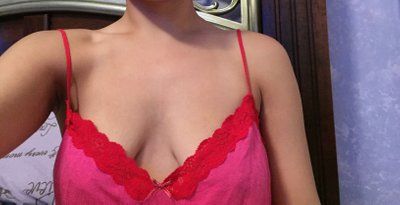 20 tuổi, nâng ngực chảy xệ kết hợp đặt túi gel silicon 475cc độ nhô cao, dưới cơ