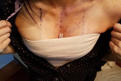 Hành trình 'trả lại" khe ngực đầy, cuốn hút với túi gel silicon Sentra, 350cc cho mẹ hai con 34 tuổi, 1m67, 52kg