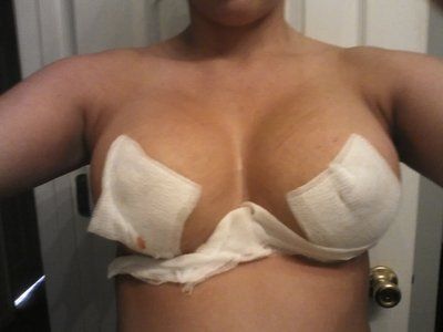 Hành trình “hô biến” ngực chảy xệ trở nên cao đầy với túi gel silicon Mentor 275cc độ nhô cao