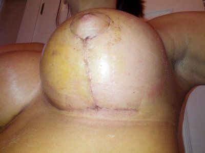 Hành trình “hô biến” ngực chảy xệ trở nên cao đầy với túi gel silicon Mentor 275cc độ nhô cao