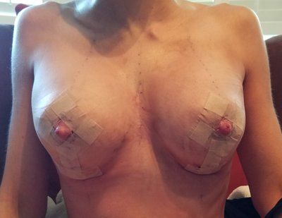 Hành trình 'trả lại" khe ngực đầy, cuốn hút với túi gel silicon Sentra, 350cc cho mẹ hai con 34 tuổi, 1m67, 52kg