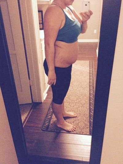 Mẹ 2 con với hành trình nâng ngực chảy xệ qua đường mổ dọc đứng hình cây kẹo kết hợp đặt túi gel silicon vỏ nhám, độ nhô cao, trên cơ.