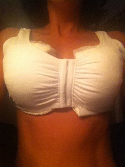 Chia sẻ hành trình nâng ngực chảy xệ kết hợp đặt túi gel silicon 425cc, độ nhô cao của mẹ trẻ sau sinh