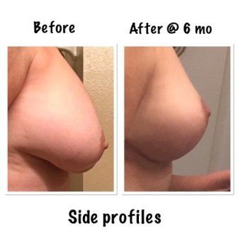 Quyết tâm nâng ngực chảy xệ kết hợp đặt túi độn của bà mẹ có tiền sử bị sẹo phì đại