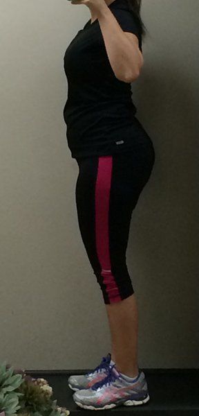 Mẹ 2 con, 34 tuổi căng da bụng kết hợp hút mỡ hai bên hông và kết quả hơn cả mong đợi