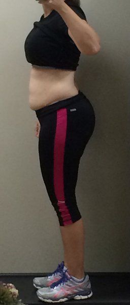 Mẹ 2 con, 34 tuổi căng da bụng kết hợp hút mỡ hai bên hông và kết quả hơn cả mong đợi