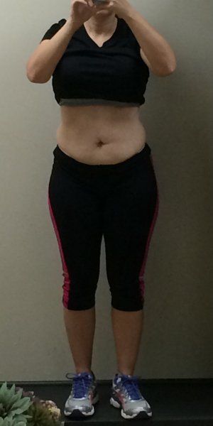 Mẹ 2 con, 34 tuổi căng da bụng kết hợp hút mỡ hai bên hông và kết quả hơn cả mong đợi