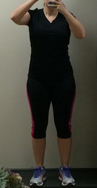 Mẹ 2 con, 34 tuổi căng da bụng kết hợp hút mỡ hai bên hông và kết quả hơn cả mong đợi