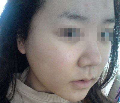 Hành trình hút mỡ má và cằm đôi tạm biệt khuôn mặt mũm mĩm của cô gái 23 tuổi