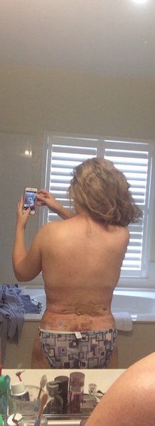 Cùng theo dõi quá trình hút bỡ hai bên hông, sườn và lưng của bà mẹ 46 tuổi