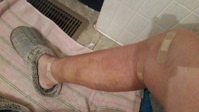 Quá trình hút mỡ bắp chân và mắt cá chân