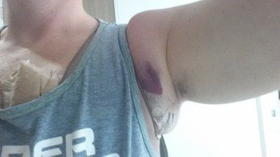 Hút mỡ cho nam giới: quý ông 40 tuổi với hành trình hút mỡ ngực, hai bên sườn, bụng, lưng