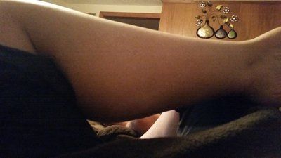 Quá trình hút mỡ bắp chân và mắt cá chân
