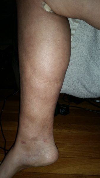 Quá trình hút mỡ bắp chân và mắt cá chân