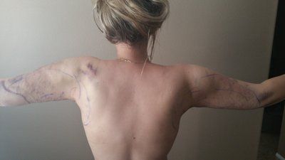 Xuyên suốt quá trình hút mỡ bắp tay của cô gái trẻ