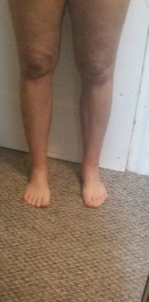 Quá trình hút mỡ bắp chân và mắt cá chân