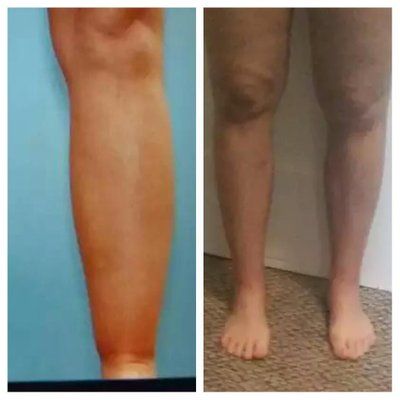 Quá trình hút mỡ bắp chân và mắt cá chân
