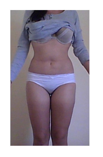 Hành trình hút mỡ đùi trong và xử lý vùng da sần vỏ cam