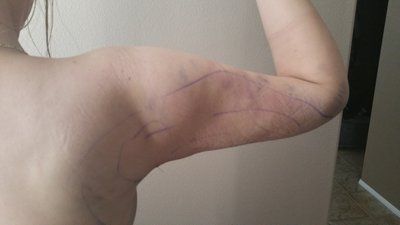 Xuyên suốt quá trình hút mỡ bắp tay của cô gái trẻ