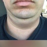 Quá trình xóa cằm đôi di truyền của quý ông 31 tuổi