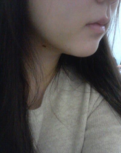 Hành trình hút mỡ má và cằm đôi tạm biệt khuôn mặt mũm mĩm của cô gái 23 tuổi