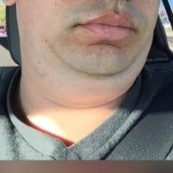 Quá trình xóa cằm đôi di truyền của quý ông 31 tuổi