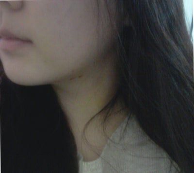 Hành trình hút mỡ má và cằm đôi tạm biệt khuôn mặt mũm mĩm của cô gái 23 tuổi