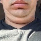 Quá trình xóa cằm đôi di truyền của quý ông 31 tuổi