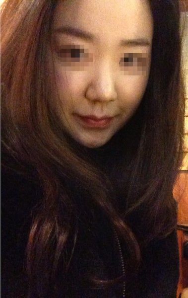 Hành trình hút mỡ má và cằm đôi tạm biệt khuôn mặt mũm mĩm của cô gái 23 tuổi