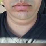 Quá trình xóa cằm đôi di truyền của quý ông 31 tuổi