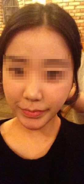 Hành trình hút mỡ má và cằm đôi tạm biệt khuôn mặt mũm mĩm của cô gái 23 tuổi