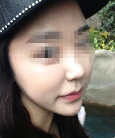 Hành trình hút mỡ má và cằm đôi tạm biệt khuôn mặt mũm mĩm của cô gái 23 tuổi