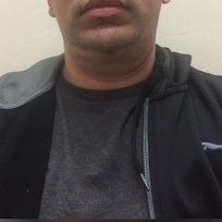 Quá trình xóa cằm đôi di truyền của quý ông 31 tuổi