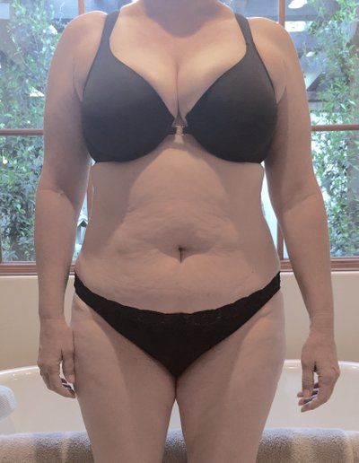 Quá trình hút mỡ căng mô ở bụng, hai bên sườn và hai bên đùi trong của bà mẹ 53 tuổi