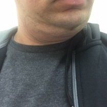 Quá trình xóa cằm đôi di truyền của quý ông 31 tuổi