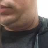 Quá trình xóa cằm đôi di truyền của quý ông 31 tuổi