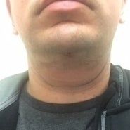 Quá trình xóa cằm đôi di truyền của quý ông 31 tuổi