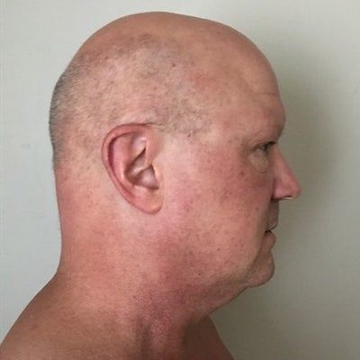 Quý ông hút mỡ cằm với kết quả ngoài sức tưởng tượng, trông trẻ hơn 15 tuổi
