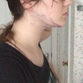 Cô gái trẻ 24 tuổi với quy trình hút mỡ góc cằm cổ