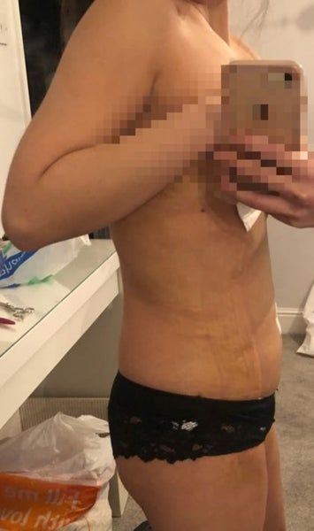 Theo dõi trải nghiệm 2 lần hút mỡ bằng sóng siêu âm Vaser cho vùng bụng trên/dưới, hai bên sườn và lưng