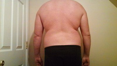 Hút mỡ cho nam giới: quý ông 40 tuổi với hành trình hút mỡ ngực, hai bên sườn, bụng, lưng